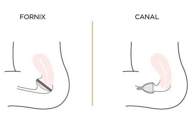Fornix-vs-Canal-menstrual-disc-placement-edited Nixit Menstrual Cup | Personal Review and Cup Comparisons